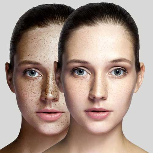 image of the Freckles Removal treatment